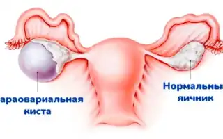 Параовариальная киста