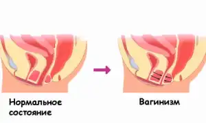 Вагинизм