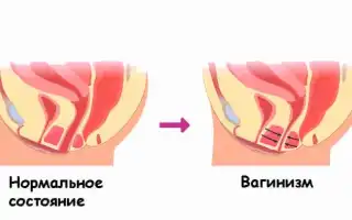 Вагинизм