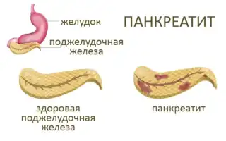 Как убрать интоксикацию в организме при панкреатите