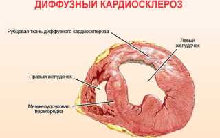 Диффузный кардиосклероз: как обнаружить и лечить