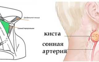 Киста шеи