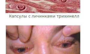 Трихинеллез