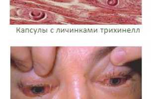 Трихинеллез