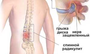 Радикулит