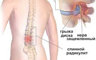 Радикулит