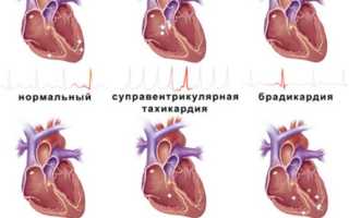 Тахикардия