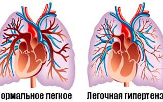 Легочная гипертензия