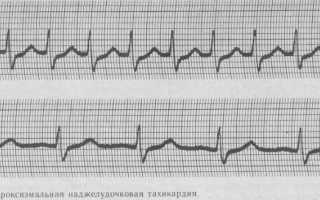 Что такое кардиоверсия, показания, проведение, прогноз