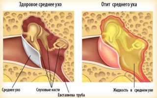 Отит