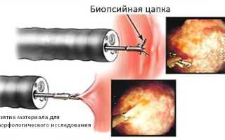 Постмиокардический кардиосклероз: признаки, лечение, прогноз