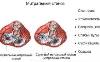 ЭКГ-признаки гипертрофии правого желудочка