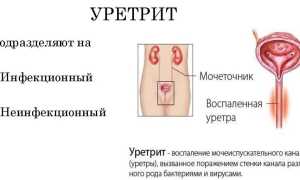 Уретрит