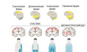 Детский церебральный паралич