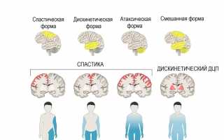 Детский церебральный паралич
