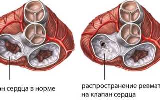 Ревмокардит сердца: признаки, классиикация, лечение