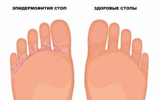 Инкубационный период микоза стопы