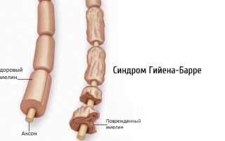 Синдром мышечной гипотонии у детей и взрослых