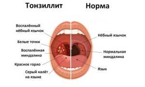 Тонзиллит