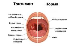 Тонзиллит
