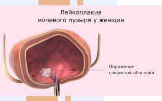 Лейкоплакия мочевого пузыря
