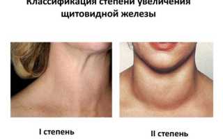 Диффузные изменения щитовидной железы