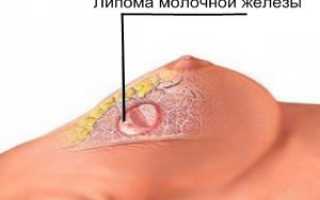 Липома молочной железы