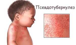 Псевдотуберкулёз