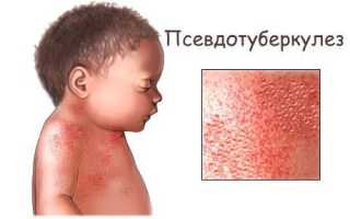 Псевдотуберкулёз