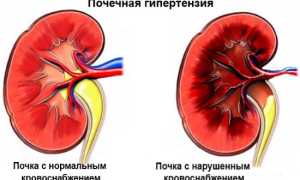 Почечное давление — что это такое, симптомы, как снизить