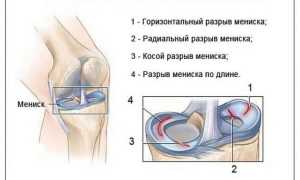 Разрыв мениска