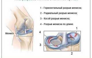 Разрыв мениска