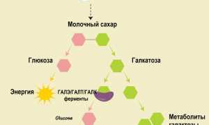 Галактоземия