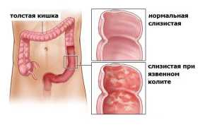 Неспецифический язвенный колит