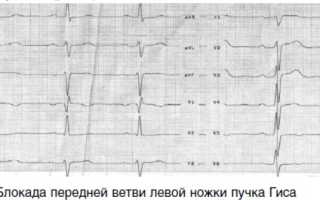 Что такое внутрижелудочковые блокады, симптомы и лечение