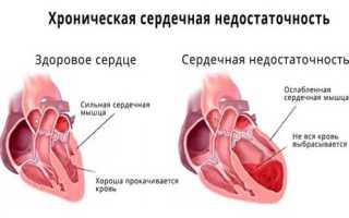 Что такое артериальная гипотензия, ее причины, симптомы и лечение