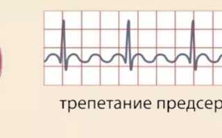 Трепетание предсердий: классификация, ЭКГ-признаки, причины, лечение