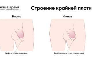 Фимоз