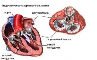 Порок сердца: виды, лечение, продолжительность жизни