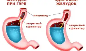 Рефлюкс