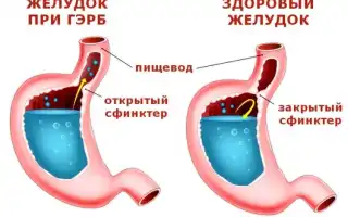 Рефлюкс