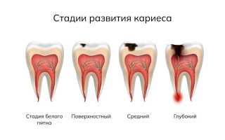 Кариес