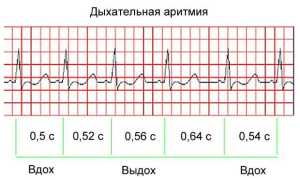 Чем опасна синусовая аритмия сердца, ее причины и лечение