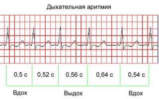 Чем опасна синусовая аритмия сердца, ее причины и лечение