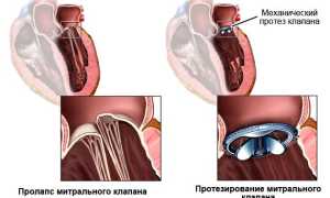 Что такое миксома сердца