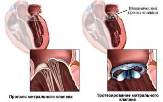 Что такое миксома сердца