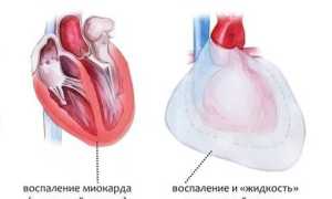 Покалывание в области сердца — что это может быть, причины, лечение