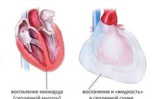 Покалывание в области сердца — что это может быть, причины, лечение