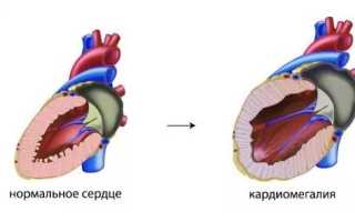 Кардиомегалия: причины, симптомы, диагностика и лечение