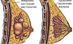 Мастопатия